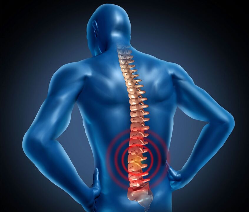 Osteocondrose lumbar