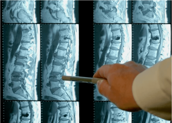 Variedades de osteocondrose na columna vertebral