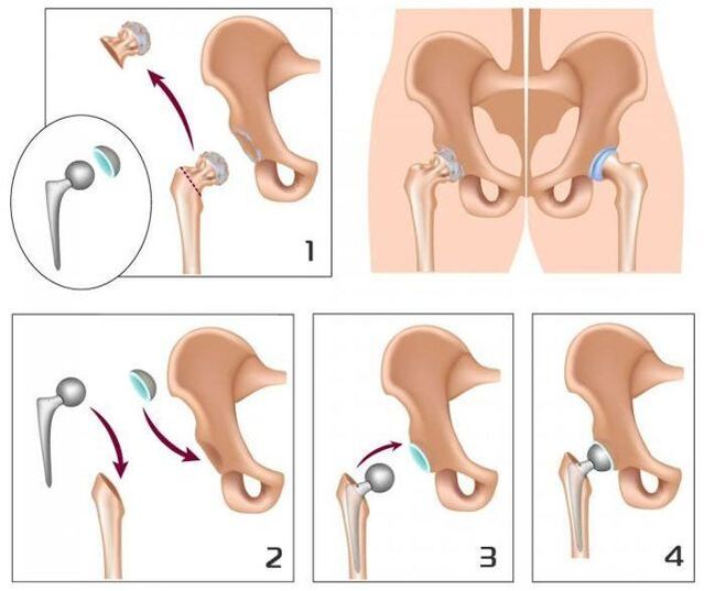 Substituíndo unha articulación dolorida por unha prótese
