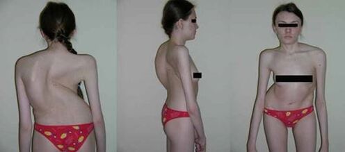 curvatura da columna vertebral como consecuencia da osteocondrose