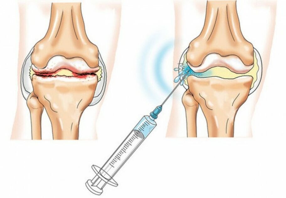 inxección na articulación do xeonllo con artrose