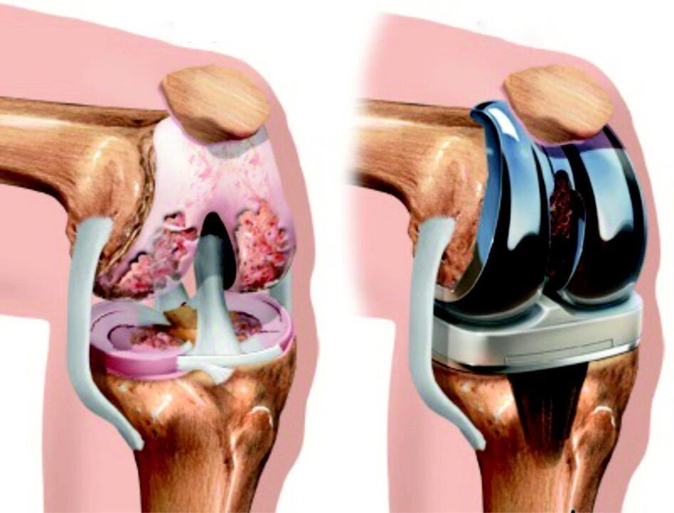 En caso de dano total á articulación do xeonllo por artrose, pódese restaurar mediante endoprótesis. 