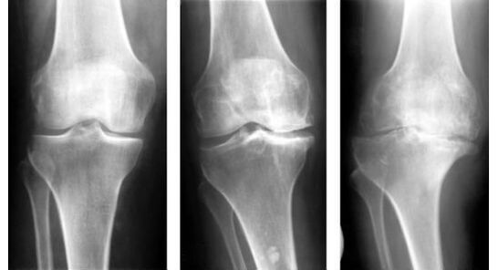Unha medida de diagnóstico obrigatoria para identificar a artrose do xeonllo é unha radiografía